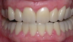 Full-smile rehabilitation - after treatment
