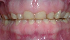Full-smile rehabilitation - before treatment