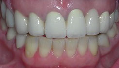 Smile restoration - after treatment