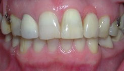 Smile restoration - before treatment