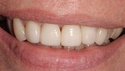 Complete smile makeover - after treatment