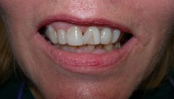 Complete smile makeover - before treatment