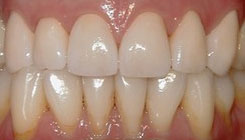 Worn & fractured teeth - after treatment