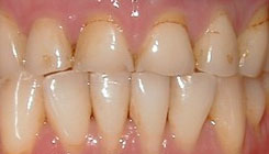 Worn & fractured teeth - before treatment
