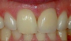 Missing front tooth - after treatment