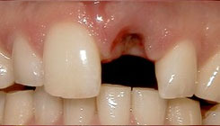 Missing front tooth - before treatment