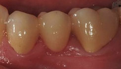 Porcelain fixed bridge - after treatment