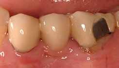 Porcelain fixed bridge - before treatment