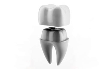 A porcelain crown being seated over a prepared tooth