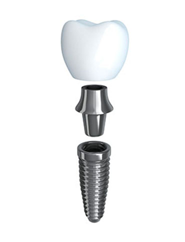 The three parts of a dental implant: crown, abutment and implant